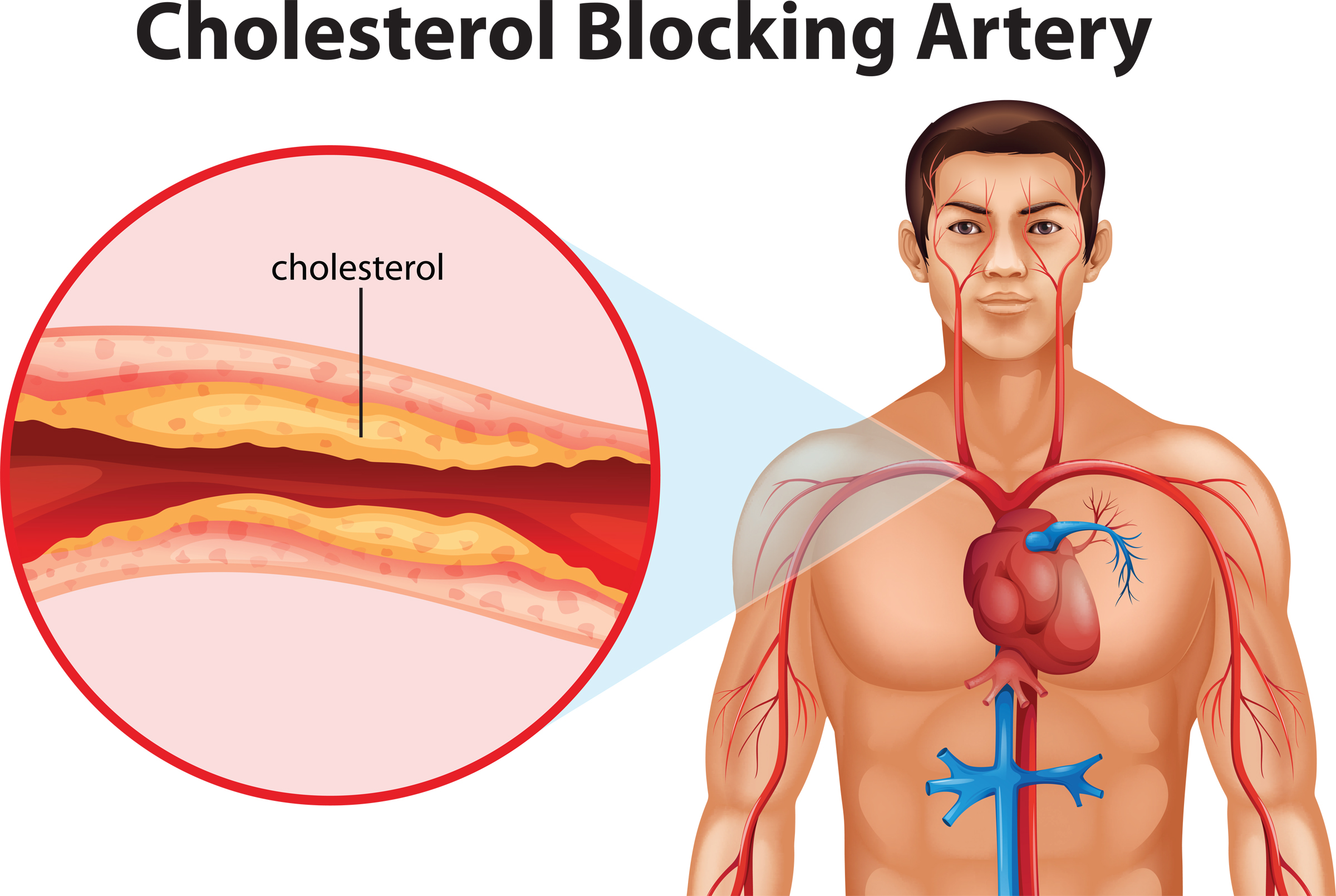 cholesterol_sys_2